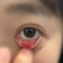 새봄동물병원 | [임산부 다래끼 치료 후기] 임신 24주차 다래끼 째기, 임산부 항생제, 임산부 안약, 자연치유 실패