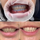 참사랑치과기공소 | 치과 치아미백 3회 비용 시간 원데이 내돈내산 후기