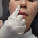 분당피부과, 미친스킨부스터 콜라겐주사 올리디아365 통증,효과,찐후기