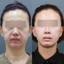 거상광고 | 안면거상 후기, 이 '3가지'는 꼭 확인하셔야 합니다 <대표원장 작성>