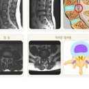 척추 협착증 증상 및 원인과 치료방법(수술) 허리 척추관 협착증 운동 증세 이미지