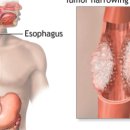 식도암[esophageal cancer] 이미지