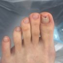 세류동 1258-2 | 수원문제성발톱 발톱클리닉 스케일링 후기 (세로줄,변색)