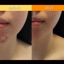 수험생 뒤집힌 피부, 림프 순환이 해답 [강변역 뷰티라인업 피부관리]