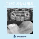 청량리치과 사랑니 발치, 고난도 케이스는 왜 신중해야 할까?