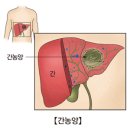 간농양(Liver abscess) 이미지