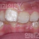 인비스치과의원 | 창원교정치과, 어린이 투명교정 치료 케이스 후기