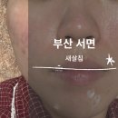 ㅣ부산 새살침 3회차 후기, 통증, 가격ㅣ서면 흉터 전문 한의원ㅣ여드름 흉터 관리ㅣ
