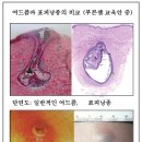 여드름과 혼동 되는 표피 낭종 이미지