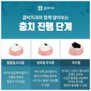 크라운 지르코니아 비교해보고 이미지