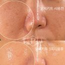 주식회사 바비앤죠 | 요즘 핫한 스피큘 모공관리 홈케어 / 비반콴트망카 키트 솔찍 후기 / 모공 인플란트