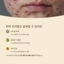 이로운짐 | 카무트 효소 부작용? 방귀, 설사, 여드름 반응까지 실제 후기 분석