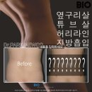 지방흡입 후 지방흡입붓기 (비아이오성형외과박재우)