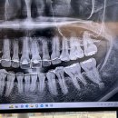 삼송서울치과의원 | [삼송역 치과] 서울오늘치과의원 (feat. 어금니 신경치료와 인레이 비용과 마취주사 통증)