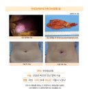 만성담낭염수술후. 평상시에 과식하거나 기름진 음식을 먹고나면 위경련 같이 넘 아팠어서... 이미지