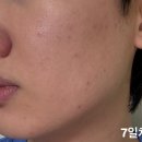 레디카 | 14일만에 모공, 트러블 이 정도로 효과본다고? &#39;비레디 시카페인 세럼 &amp; 크림&#39; 사용 후기