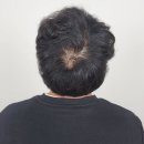 제이비 | M자이마·가르마·정수리 강남두피문신 후기 | 제이비탈모해결