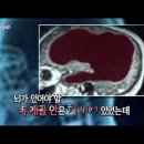 뇌가 없는데 IQ126이라고? --- “노화로 뇌 위축돼도 남은 신경세포가 기능 보완” 이미지