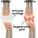 류마티스 관절염 or 퇴행성 관절염 이미지
