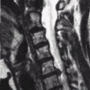 디스크 (경추 추간판 탈출증, Cervical HIVD) 이미지