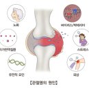 골 관절염(퇴행성 관절염,서울아산병원) 이미지