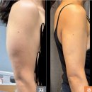 믿음메디칼약국 | 꿀팁] 30kg 감량도 못 뺀 팔뚝, 서울365mc 지방흡입 1년 후기 / 근육 많은 팔뚝 지흡 효과는 얼마나...