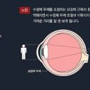 노안 원인 증상 진단 치료 수술 이미지