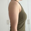 멍둥이 | 대전 팔뚝 지방분해주사 용량과 멍 변화 후기