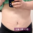 몸의형태 | [복부지방분해주사 3차 후기] 숫자보다 먼저 느껴지는 변화, 몸의 ‘라인’이 달라지다