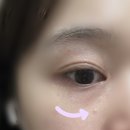 아름다운피부과의원 | [안산 상록수역] 비립종 빼러 간 아름다운피부과