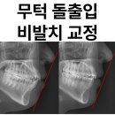 O.K.Line치과의원 | 비발치 무턱 돌출입 교정, 심미선으로 보는 돌출입 판단 기준, 문정동 교정치과