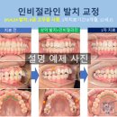 웃는E치과교정과치과의원 | 인비절라인 치료로 발치 교정치료가 되나요? 웃는E치과교정과