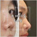 압구정성형외과 - 코재수술 비용, 6개월 후기