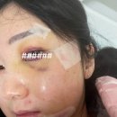 카성형외과 | 광대 및 안와 골절 재건술 후기 한림대 성형외과 수술 및 입원 과정