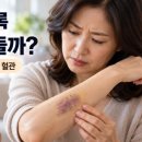 나이들수록 툭하면 멍이 드는 이유 이미지
