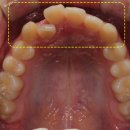서울라미플란트치과교정과치과의원 | 춘천교정치과, 상악 전치부 크라우딩 + 반대교합 교정 치료 후기