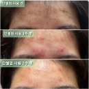 비투아비 | 인셀덤/인셀덤후기/성인여드름/트러블 케어해주다