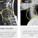 목디스크 치료방법 운동 목디스크 원인 증상 이미지