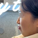 서면금약국 | 서면코수술 1년차 후기 매부리코 개선 내돈내산 찐 후기