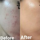 [행복의 공식] 청탁금지법 | 피부과 없이 여드름 홈케어 N년차 후기 꿀팁 총정리 Part1 생활습관 + 내돈내산 기초 화장품 추천