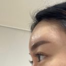 본죽 전주송천점 | [내돈내산] 이마필러통증 턱끝필러후기 (당일~3일차) 측두근보톡스후기