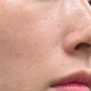 고우리 | 부산 서면피부과 | 콜라겐 스킨부스터 고우리부스터 후기(엠보, 붓기, 효과)