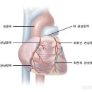 죽상 동맥경화증 이미지