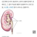 3번째 요로결석 시술 후기 증상 및 발생이유 수술비용