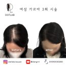 연제구-020 | 가르마 탈모 두피문신으로 풍성하게 탈바꿈!(f. 가르마 탈모의 원인)