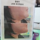 블링헤어 | 사직동 뽀블링 스칼프- 헤어라인문신 후기 자연스럽게 예뻐지는 방법