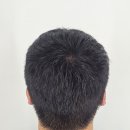 그레이트여성의원 | 원주 머리문신 smp 피해야할 업체는?