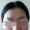 바로보고한의원 | 여드름 한의원 후기 나한테 필요한 치료만 해줬던 곳