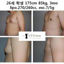 [여유증수술전후] 26세 학생 175cm 85kg, 3mo lipo.270/260cc, exc.7/5g _5 이미지