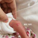 고신대학교 | 아기 혈관종 치료, 고신대학교병원 영아 혈관종 치료 후기